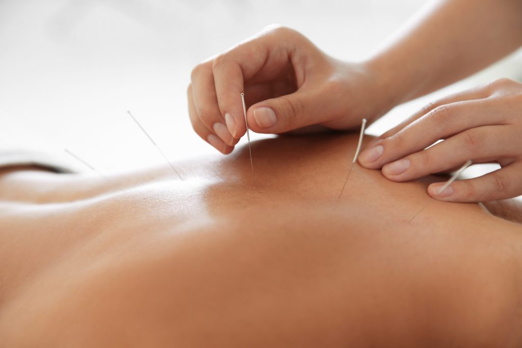 Acupuncture therapy